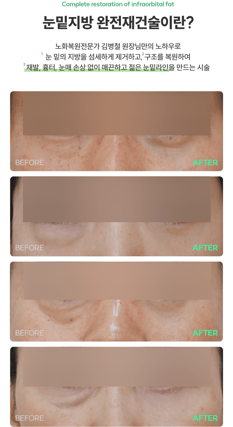 눈밑지방재배치청담EL