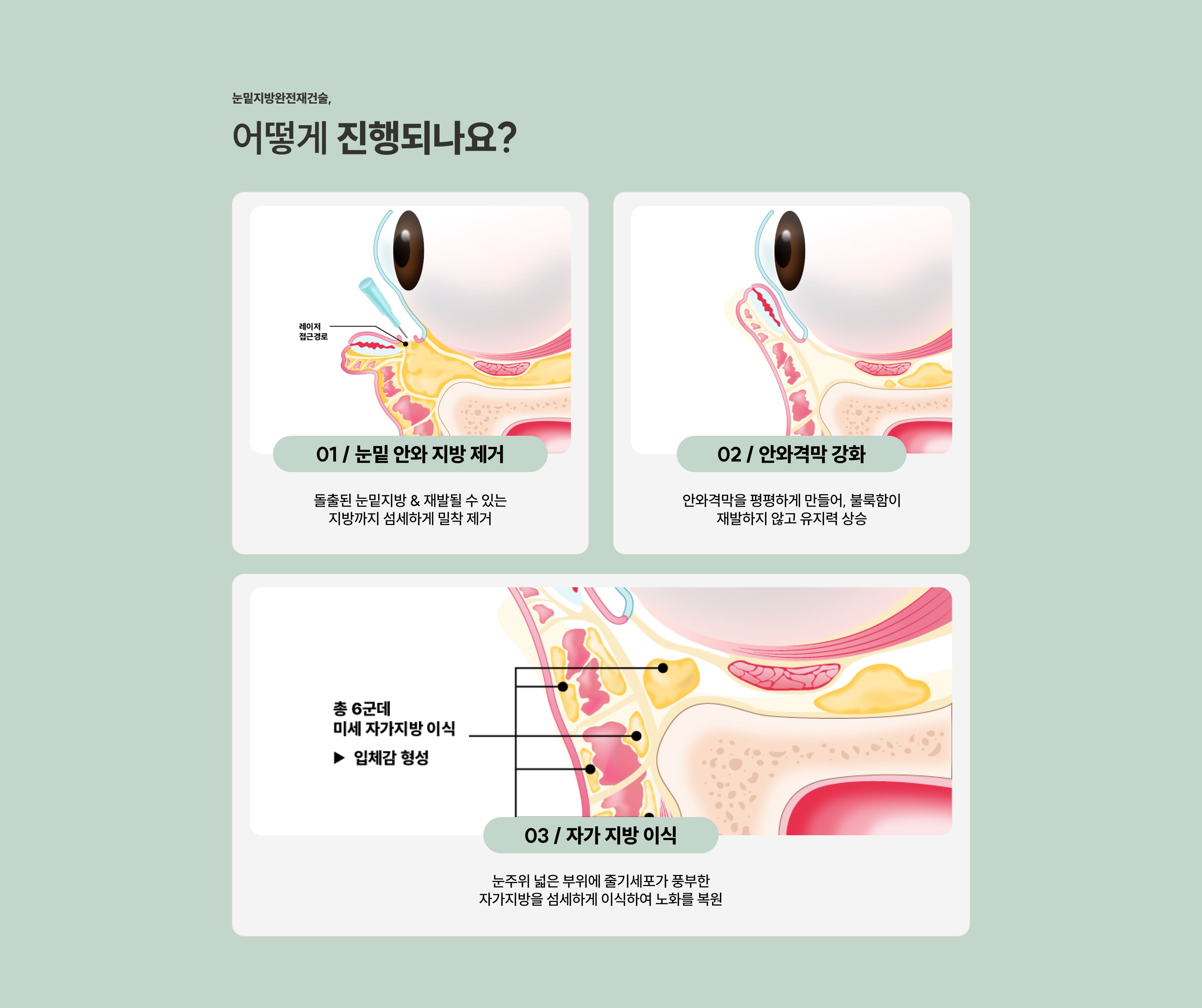 눈밑지방재배치청담EL