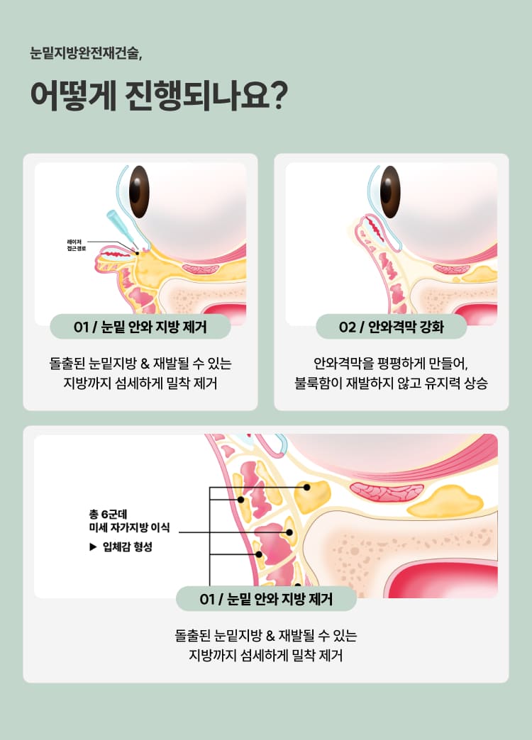 눈밑지방재배치청담EL