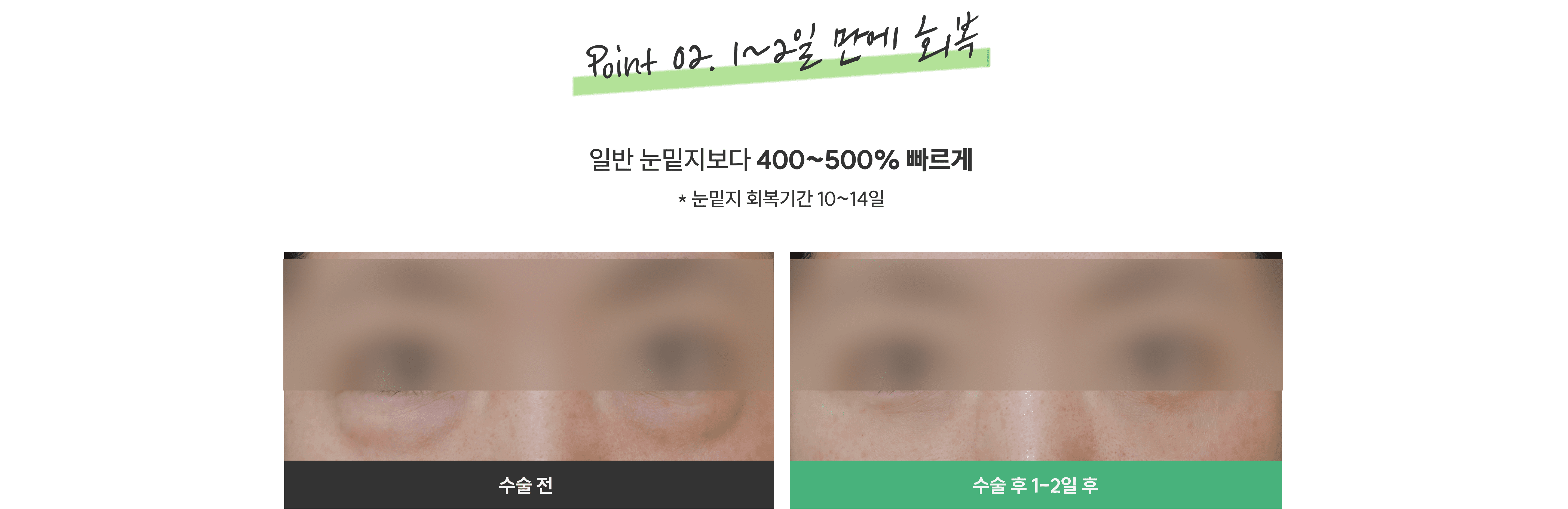 눈밑지방재배치청담EL