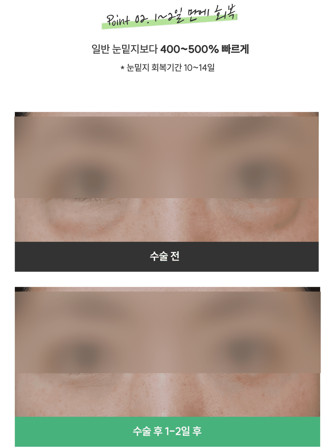 눈밑지방재배치청담EL